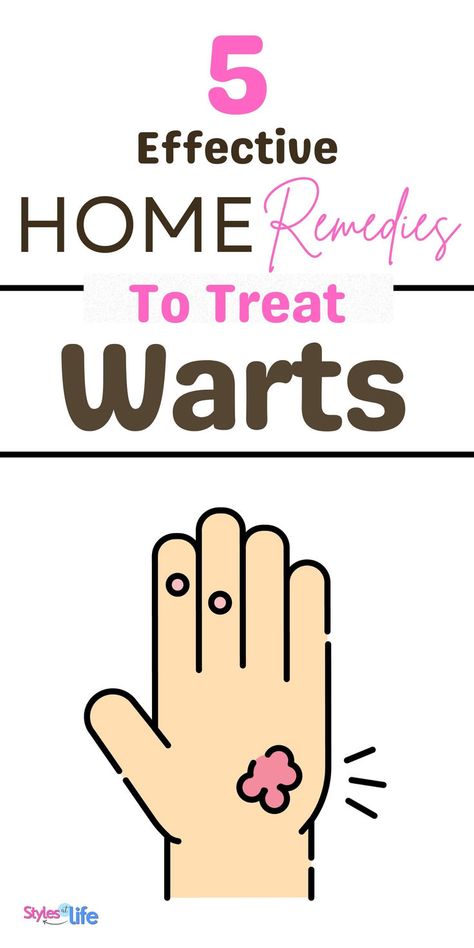 Home Remedies For Warts Home Remedy For Warts, Flat Warts, Types Of Warts, Warts On Face, Home Remedies For Warts, Warts Remedy, Get Rid Of Warts, Skin Problems, Herbal Medicine