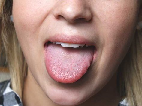 Sore Tongue, Ulcer On Tongue, Tongue Problems, Tongue Sores, Remove Skin Tags Naturally, Canker Sore, Vitamin Deficiency, Tongue Health, Dry Mouth