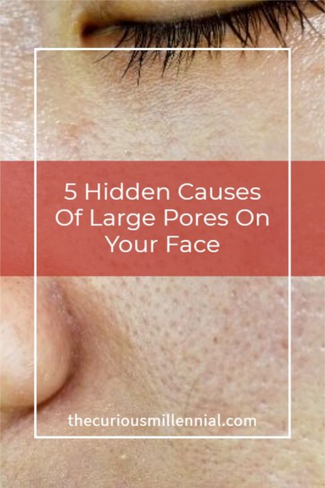 How To Reduce Pores, Large Pores Makeup, Big Pores On Face, Skin Routine For Acne, Large Pores On Nose, Facials For Acne, At Home Facials, Clear Back Acne, Open Pores On Face