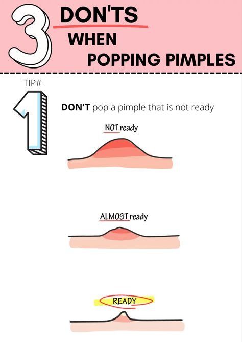 What pimples should you not pop? When to leave a pimple alone. Although people can pop some noninflamed whiteheads and blackheads if they take the necessary precautions, they should never try to pop or extract inflamed acne. This type of acne is deeper in the skin and may be more likely to cause scarring and infection if a person tries to squeeze it Essential Yoga Poses, Healthy Liver Diet, Popping Pimples, Clear Skin Routine, Blind Pimple, Pimples Under The Skin, Beauty App, Face Care Routine, Effective Workout Routines