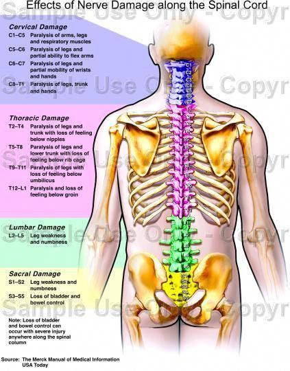 Effects of Nerve Damage Along the Spinal Chord ~ Infographic Spinal Nerves Anatomy, Nerve Anatomy, Spinal Nerve, Human Body Anatomy, Spine Health, Sciatic Nerve Pain, Human Anatomy And Physiology, Medical Anatomy, Nerve Damage