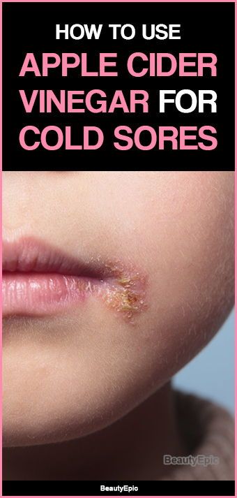 Cold Sore Scab, Cold Sore Remedy Fast, Cold Sore Remedy Overnight, Natural Cold Sore Remedy, Canker Sore Remedy, Cold Sore Relief, Too Legit To Quit, Diy Home Products, Allergies Remedies