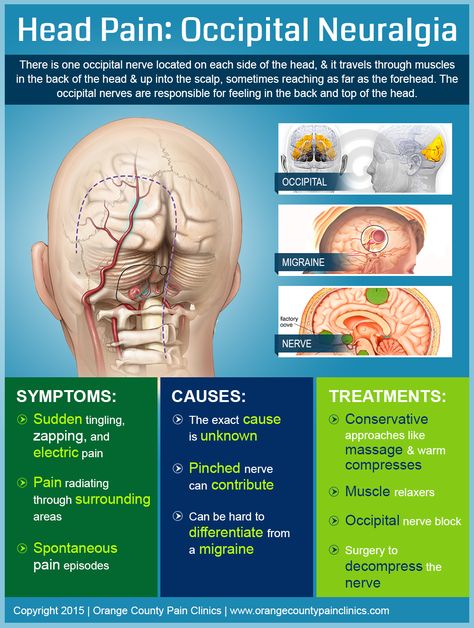 Head Pain Occipital Neuralgia Headache Map, Migraine Tips, Occipital Nerve Block, Migraine Help, Occipital Neuralgia, Muscle Knots, Chiari Malformation, Head Pain, Cervical Spine