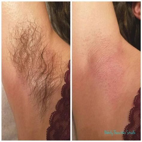 Before and after underarm wax! I recommend starting this in the winter months when we wear long sleeves so that we can hide our hair growth! It'll be thinned out come short sleeve weather. #dayton #ohio #brazilianwaxing #waxspecialist #waxing #esthetician #mensbrazilianwaxing #eyebrowwaxing #waxpro #beforeandafter #underarmwax Waxing Before And After, Waxing Esthetician, Natural Eyebrows Growth, Underarm Waxing, Wax Studio, Ingrown Hair Removal, Waxing Salon, Shaving Tips, Peeling Mask