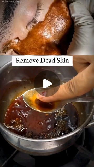 Face Remove Hair, How To Remove Dead Skin, How To Remove Dead Skin From Face, Black Head Remover Diy, Dead Skin On Face, Face Waxing, Diy Facial Hair Removal, Blackheads On Face, How To Remove Blackheads