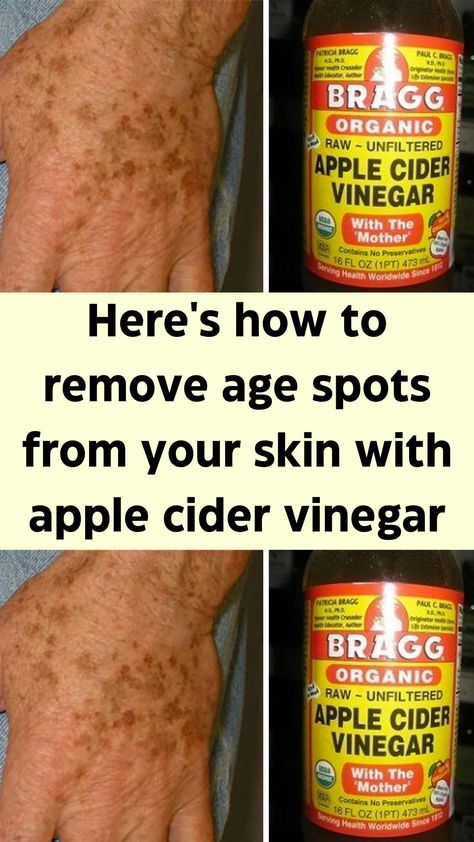 Age spots, the bane of sun worshipers existence in their older age. Indeed, age spots are often associated more with “age” then the cause of them, which is increased exposure to the rays of the sun over many years. Therefore, a younger person could also experience them if they were an over-frequent user of the tanning beds, for example. Typically it is those with fairer skin who experience age spots more often in life as their skin is more vulnerable to the sun’s rays Diy Age Spot Remover The Face, Remove Brown Spots On Skin, Dark Spot On Face Remedies, Leg Skin Care Dark Spots, Diy Age Spot Remover, Natural Age Spot Remover, Get Rid Of Age Spots On Face, Removing Sun Spots On Face, Remove Age Spots On Face