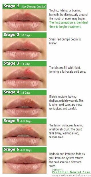 Cold sore stages Lip Sores, Cold Sore Stages, Cold Sore Lip, Cold Sore Remedy, Fever Blister, Cold Sore Remedies, Canker Sore, Cold Sores, Cold Sores Remedies