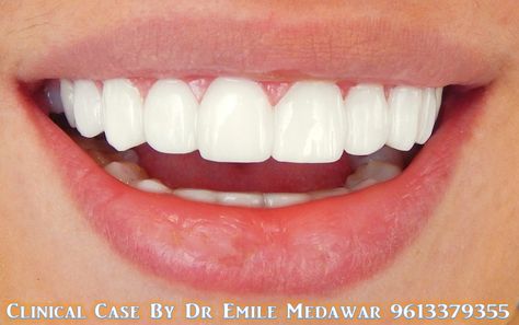 Hollywood Smile Veneers, Dental implant in Lebanon, Style Dental Clinic, Dentist in Beirut Lebanon, 00961 3 379355 Teeth Aesthetic, Pretty Teeth, Veneers Teeth, Beautiful Teeth, Straight Teeth, Porcelain Veneers, Perfect Teeth, Nice Teeth, Smile Teeth