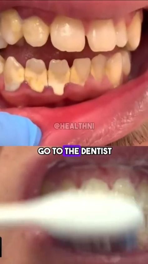 NATURAL RECIPE TO WHITTEN YOUR TEETH Homemade Teeth Whitening, Tatoo 3d, Beginner Skin Care Routine, Teeth Whitening Homemade, Teeth Whitening Diy, Face Skin Care Routine, Clear Healthy Skin, Diy Skin Care Routine, Teeth Health