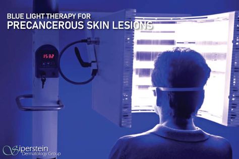 FAQs About Blue Light Therapy For Precancerous Skin Lesions Skin Lesions, Blue Light Therapy, Cleveland Clinic, The Fence, Light Therapy, Dermatology, Body Skin, Skin Cells, Blue Light