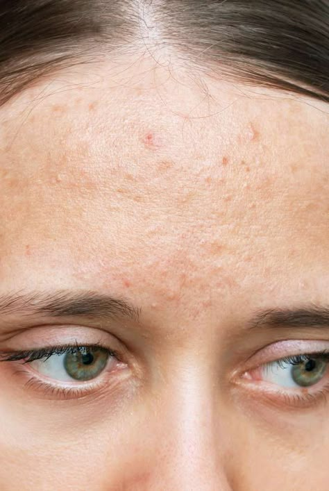 Types Of Acne On Face, Calcium Deposits On Face, Acne Cream Products, Closed Comedones, Comedonal Acne, Body Soul Mind, Healing Together, Forehead Acne, Pimple Patch