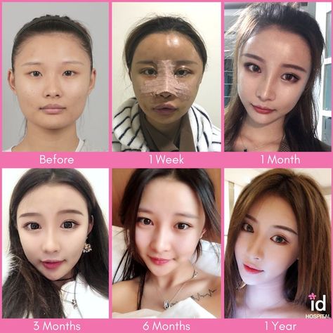 South Korean Plastic Surgery, Cheekbone Reduction, Kpop Plastic Surgery, Jaw Reduction Surgery, Forehead Reduction, V Line Surgery, Face Plastic Surgery, Nose Fillers, Plastic Surgery Korea