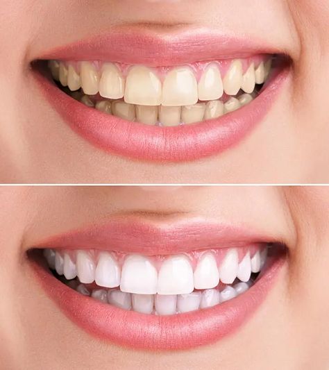 Hydrogen Peroxide For Teeth Whitening – 6 Home Remedies To Whiten Teeth Teeth Whitening Remedies, Laser Teeth Whitening, Whiter Teeth, Teeth Whitening Pen, Porcelain Veneers, Best Teeth Whitening, Natural Teeth Whitening, Teeth Whitening Kit, Whitening Kit