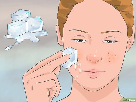 3 Ways to Get Rid of a Pimple with No Head - wikiHow Hard Pimple, Deep Pimple, Nodule Acne, Back Pimples, Painful Pimple, Rid Of Pimples Overnight, Pimples On Forehead, Acne Prevention, Cystic Pimple