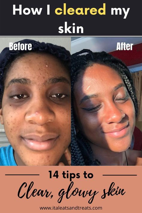 Best Product For Clear Skin, How To Naturally Clear Skin, Natural Clear Skin Tips, Face Breakout Remedies, Clear Skin Without Products, Acne Safe Recipes, No Acne Clear Skin, How To Have A Clear Face, Clear Face Remedies