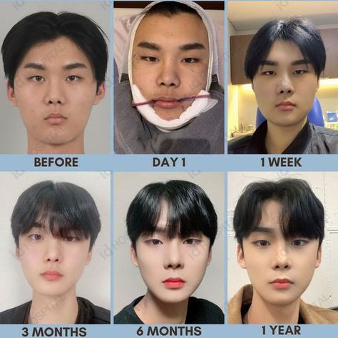 Cheekbone Reduction, V Line Surgery, Plastic Surgery Korea, Korean Plastic Surgery, V Shape Face, Nose Types, Rhinoplasty Nose Jobs, Face Surgery, Yoga Information