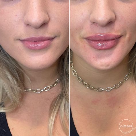 Angelic Lip Filler, Lip Filler Shapes, Lip Model, William Godward, Lips Inspiration, John William Godward, Holistic Health Remedies, Lip Filler, Upper Lip