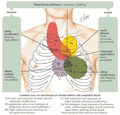 Coarctation Of The Aorta, Heart Murmurs, Heart Pressure, Atrial Septal Defect, Acute Coronary Syndrome, Differential Diagnosis, Angina Pectoris, Congenital Heart, Cardiology