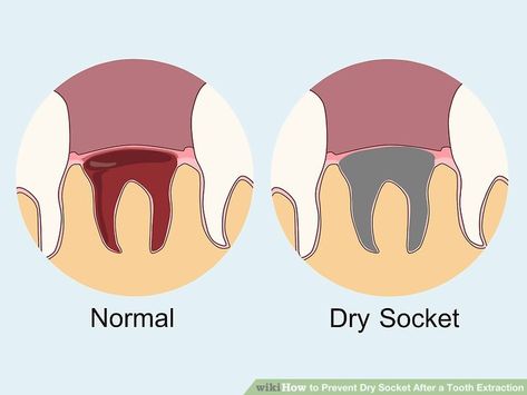 4 Ways to Prevent Dry Socket After a Tooth Extraction - wikiHow Food For After Tooth Extraction, Tooth Extraction Food, Food After Wisdom Teeth Removal, Foods To Eat After Tooth Extraction, What To Eat After Tooth Extraction, Food After Tooth Extraction, Eating After Tooth Extraction, After Wisdom Teeth Removal, Teeth Surgery