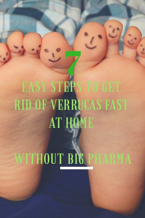 Got a stubborn verruca? This tried and tested home remedy gets rid of verrucas fast. No pharmaceuticals required. Read full blog post to find out how to get rid of verrucas for good. Pretty Pins, Big Pharma, Diy Recipes, Diy Food Recipes, Easy Step, Natural Health, Home Remedies, Health And Wellness, Blog Post