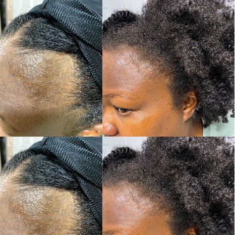 Hair Growing Oil, Natural Hair Edges, Best Hair Growth Vitamins, Alopecia Hair Growth, Hair Grow Oil, Hair Growth Regimen, Damaged Hair Diy, Herbs For Hair Growth, Rosemary Hair Growth