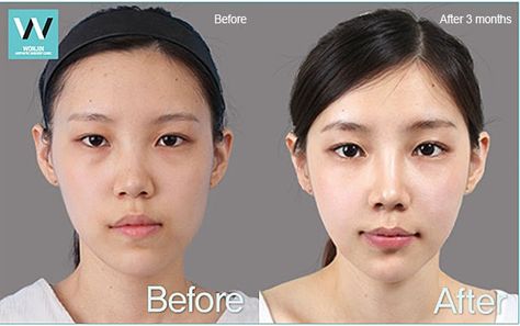 best plastic surgery clinic in korea: Facial asymmetry correction Before and After Plastic Surgery Korea Before After, Facial Asymmetry Correction, Facial Assymetry, Plastic Surgery Before And After, Face Asymmetry, Facial Asymmetry, Aesthetic Facial, Face Symmetry, Facelift Surgery