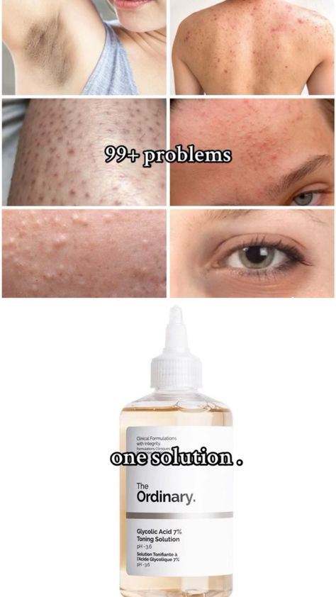 The Ordinary Back Acne, No Hyperpigmentation, Ordinary For Dark Spots, Best Acids For Skin, Products For Back Acne, Skin Care Textured Skin, Best Products For Hyperpigmentation, What To Use For Dry Skin On Face, Good Exfoliator For Face