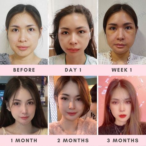 Cheekbone Reduction, Beauty Surgery, V Line Surgery, Plastic Surgery Korea, Korean Plastic Surgery, V Shape Face, Face Surgery, V Face, Jaw Surgery