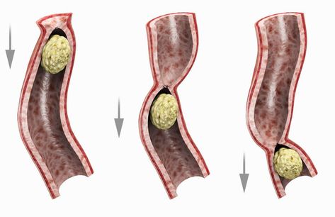 What Can Cause An Ileus? Nursing Skills, Abdominal Surgery, Muscle Contraction, Slow Down, Surgery, Nursing, Health, Quick Saves