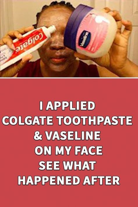 I applied Colgate toothpaste & Vaseline on my face see what happened after Vaseline For Face, Healthy Face Skin, Face Wrinkles Remedies, Wrinkles Remedies Face, Wrinkles Remedies, Colgate Toothpaste, Spots On Skin, Wrinkle Remedies, Healthy Face