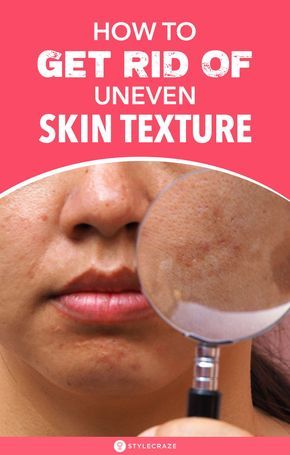 How To Get Rid Of Uneven Skin Texture On Face: If you have paid attention to the skin on your face, you would have noticed that sometimes, the texture of the skin on some areas of the face is very different from the rest of it. Want to know why this happens? We have put together a list of home remedies which will help you in treating this skin issue in a far gentler way by making use of ingredients available at home. #Skin #SkinCare #SkinCareTips Spots On Forehead, Brown Spots On Hands, Brown Age Spots, Brown Spots On Skin, Textured Skin, Brown Spots Removal, Brown Spots On Face, Uneven Skin Texture, Skin Spots