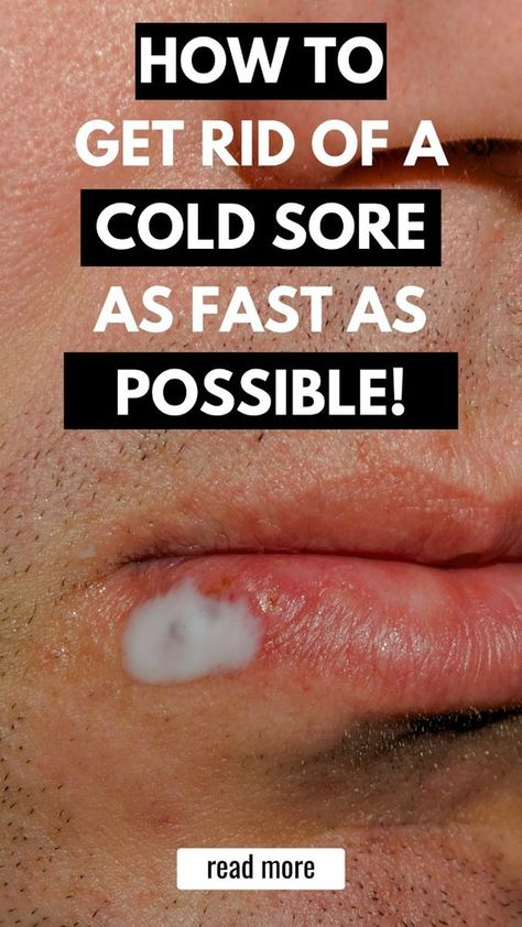 Learn how to get rid of a cold sore with these tried-and-true cold sore remedies and cold sore prevention tips. Discover the most common cold sore causes and triggers, natural remedies, over-the-counter medicines, and essential oils to help you prevent and manage cold sore outbreaks. Tap here for more tips and insights from a lifelong cold sore sufferer! #coldsore #remedies How To Get Rid Of A Cold Sore Overnight, Remedies For Cold Sore, Coldsore Remedies Quick Cold Sore, Natural Remedies For Cold Sores, Cold Sore Remedy Overnight How To Get Rid, Best Cold Sore Remedy Overnight, Cold Sores Remedies Overnight, Diy Cold Sore Remedy Fast, How To Get Rid Of Cold Sores