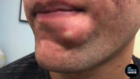 Dr. Sandra Lee, aka "Dr. Pimple Popper," said when a pimple pops "beautifully, it's like a love story." Dr Sandra Lee Pimple Popper Videos, Dr Pimple Popper Blackhead Youtube, Spot Popping Videos, Dr Pimple Poppìng Videos, Pimple Popper Videos, Ear Pimple Poppìng Videos, Pimple Pop, Pimple On Eyelid, Lip Blackheads