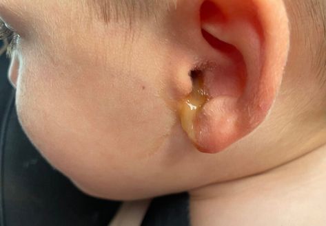 … Does Your Child Have Ear Drainage with Tubes? What It Is and When to Worry Read More » The post Does Your Child Have Ear Drainage with Tubes? What It Is and When to Worry appeared first on Just Simply Mom. How To Unstop Ears, Ear Drainage, Homemade Antibiotic, Fluid In Ears, Clogged Ears, Ear Tubes, Middle Ear, Lower Back Pain Exercises, Ear Drops