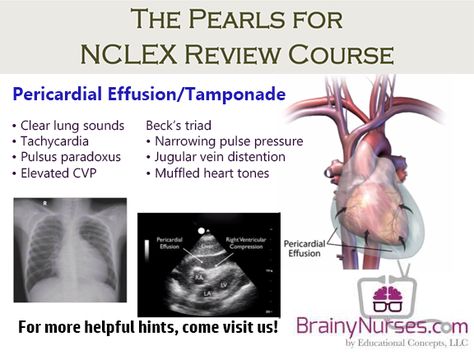 Pericardial effusion and tamponade is the accumulation of fluid or ...