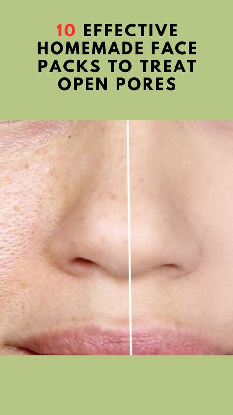 Here are 10 effective homemade face packs to treat open pores and make your skin smooth, clear, and youthful. Face Pack For Pores, How To Treat Pores On Face, Homemade Face Mask For Pores, Reduce Open Pores On Face, How To Clear Open Pores On Face, Face Pack For Open Pores, Open Pores On Face How To Get Rid, Pores On Face How To Get Rid Of, How To Reduce Open Pores On Face