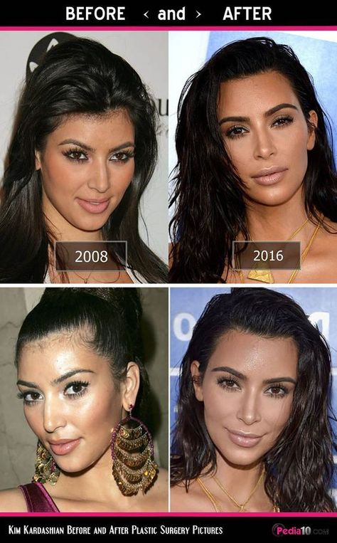 Kim Kardashian Nose, Kardashian Plastic Surgery, Kim Kardashian Eyebrows, Kim Kardashian Before, Khloe Kardashian Hair, Facial Images, Kim Kardashian Hair, Kardashian Hair, Nose Surgery