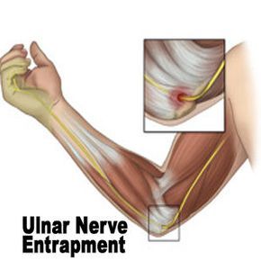 FIBROMYALGIA AND ULNA NERVE ENTRAPMENT - ARE THEY CONNECTED?... Ulnar Nerve Exercises, Nerve Exercises, Nerve Pain Remedies, Cubital Tunnel Syndrome, Ulnar Nerve, Forearm Muscles, Nerve Health, Elbow Pain, Pinched Nerve