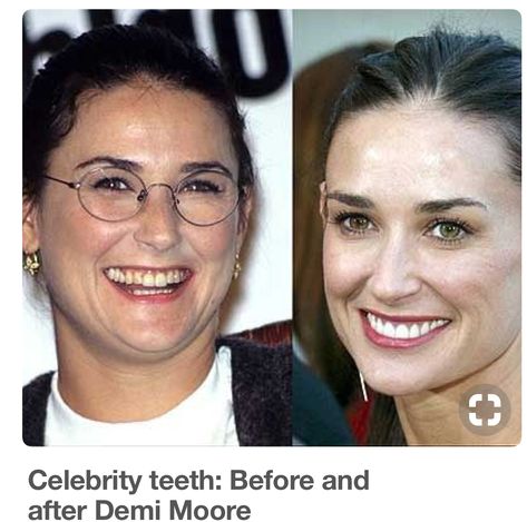 Before & After plastic surgery & teeth correction - Demi Moore Celebrity Before And After Surgery, Front Teeth Crowns Before And After, Madonna Before And After Surgery, Jaw Surgery Before And After Overbite, Teeth Correction, Celebrity Teeth, Madonna Plastic Surgeries, Veneers Teeth, Plastic Surgery Gone Wrong