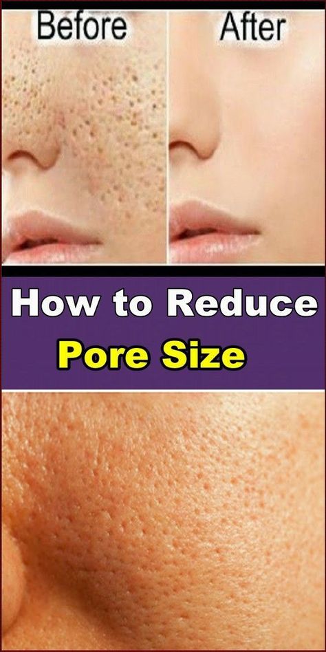 Sebum Removal, Open Pores On Face, Aveeno Clear Complexion, Pores On Face, Garden Planters Diy, Big Pores, Daily Motivation Quotes, Face Pores, Reduce Pore Size