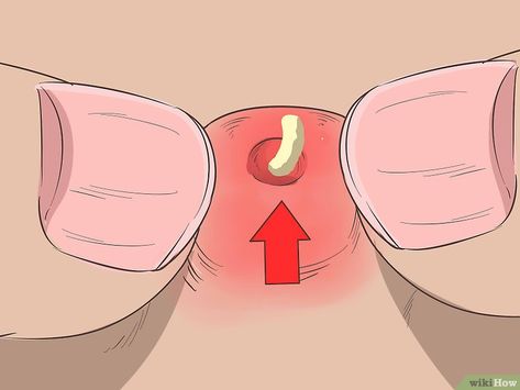 How to Instantly Get Rid of a Pimple (Cotton Ball Popping Method) Cheek Pimples, Skincare Illustration, Pimple Remedies, Pores Minimizer, Pimples On Buttocks, Get Rid Of Pimples Overnight, Banana Mask, To Remove Pimples, Acne Prevention