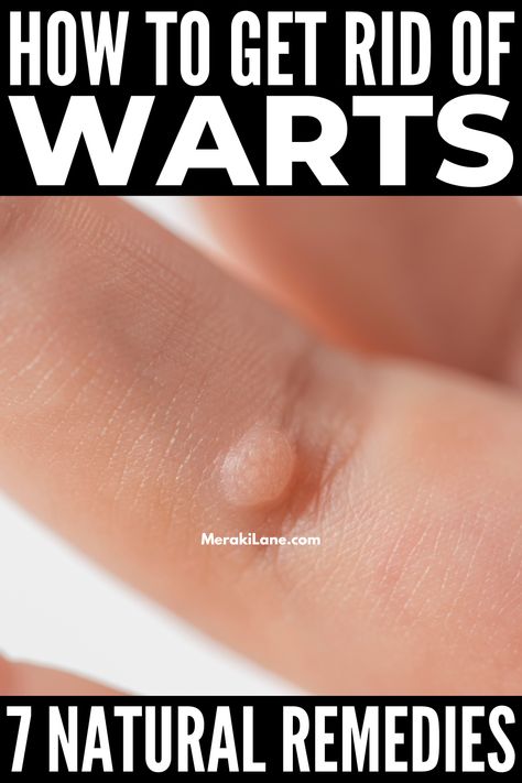 Warts On Hands, Home Remedies For Warts, Remove Skin Tags Naturally, Warts Remedy, Be Uncomfortable, Get Rid Of Warts, Home Remedy For Cough, Skin Natural Remedies, Cold Sores Remedies