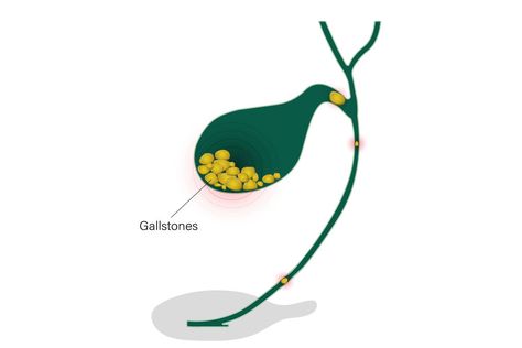 𝗖𝗮𝘂𝘀𝗲𝘀 𝗼𝗳 𝗚𝗮𝗹𝗹𝗯𝗹𝗮𝗱𝗱𝗲𝗿 𝗦𝘁𝗼𝗻𝗲 So, what exactly leads to the formation of gallbladder stones? Multiple factors contribute to their development. The primary culprits are an imbalance in the composition of bile and changes in the gallbladder’s ability to empty properly. 𝗙𝗼𝗿 𝗠𝗼𝗿𝗲 𝗜𝗻𝗳𝗼𝗿𝗺𝗮𝘁𝗶𝗼𝗻 098930 74467 https://www.shantirajhospital.com/about-gallbladder-stones/ Stone Cartoon, Gallbladder Stones, Medical Animation, Cartoon Image, Cartoon Images, Case Study, Surgery, Medical, Composition