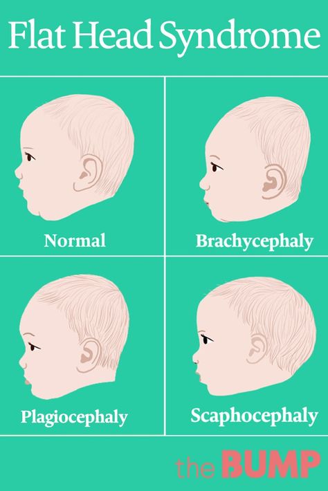 Plagiocephaly has become more common over the last few decades. Find out what causes flat head syndrome and how to prevent baby from getting it. Baby Acne Remedy, Baby Head Shape, Flat Head Baby, Orthotics And Prosthetics, Swiss Dot Blouse, Flat Head Syndrome, Advice For New Parents, Baby Helmet, Raising Twins