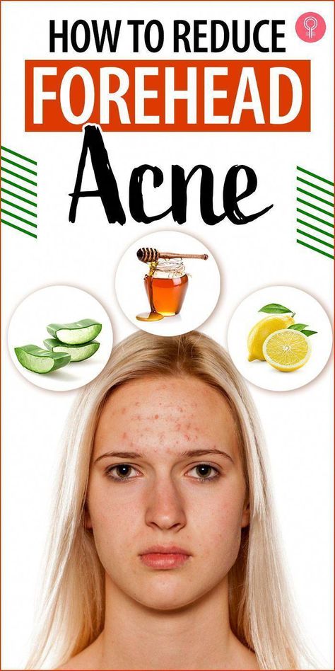 How To Reduce Forehead Acne, Forehead Acne Home Remedies, Honey And Cinnamon Face Mask, Acne On Forehead, Forehead Acne Cause, Mask For Acne Skin, Cinnamon Face Mask, Diy Face Mask For Acne, Face Masks At Home