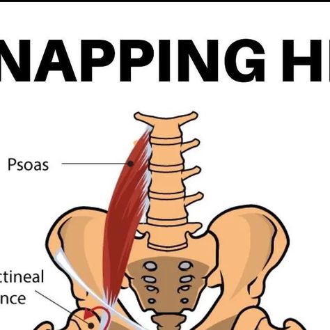 Snapping Hip Syndrome, Up Stairs, Bicycle Crunches, Hip Flexors, Hip Flexor, The Bone, Fix You, Back Pain, How To Become