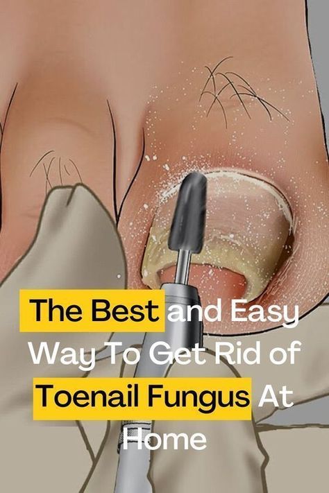 Fungal Infection Remedies, Toenail Problems, Toenail Health, Toenail Fungal Infection, Nail Remedies, Nail Fungus Remedy, Toenail Fungus Remedies, Nail Infection, Fungal Nail