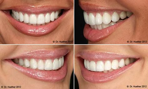 Teeth #Whitening #Greenville is a corrective dental methodology so it is proposed to enhance your grin. Teeth Makeover, Teeth Images, Natural Teeth Whitening Remedies, Pretty Teeth, Teeth Alignment, Veneers Teeth, Teeth Whitening Remedies, Beautiful Teeth, Charcoal Teeth Whitening