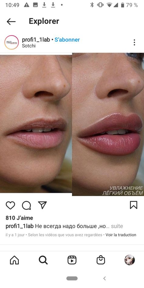 Lip Goals Filler, Lip Filler For Hydration, Downturned Lips Filler, Lip Filler Inspo Heart Shape, .5ml Vs 1ml Lip Filler, Small Lip Fillers Before And After, Lip Filler Shape Ideas 1ml, Bow Shaped Lip Filler, Lip Filler 1 Syringe