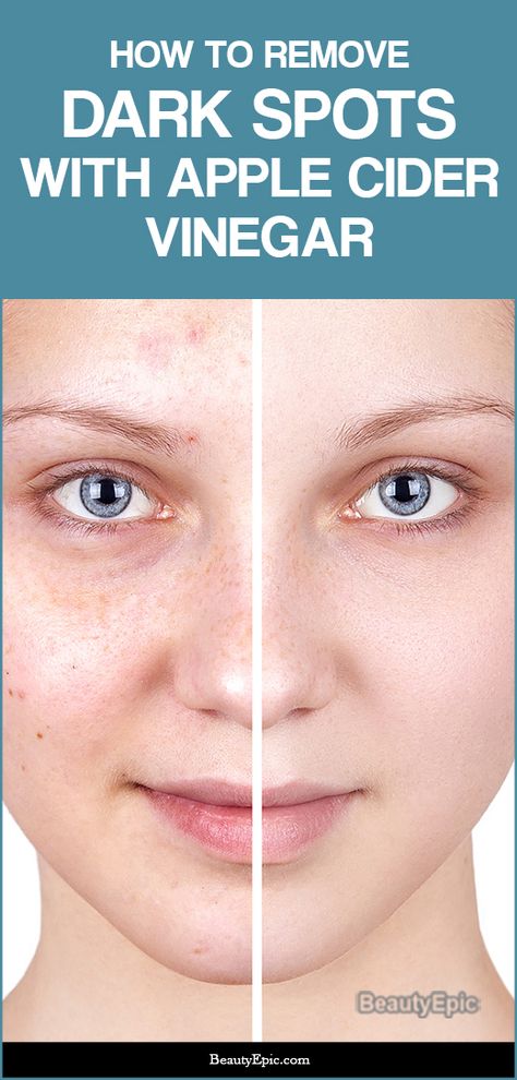 How to Remove Dark Spots with Apple Cider Vinegar Apple Cider Vinegar For Skin, Baking Soda Face, Brown Spots On Skin, Dark Spots On Face, Brown Spots Removal, Brown Spots On Face, Dark Spots On Skin, Natural Sleep Remedies, Spots On Face